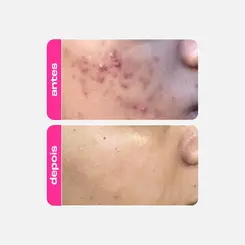 ÁCIDO MANDÉLICO CREAMY - GEL CLAREADOR ANTIACNE 30G