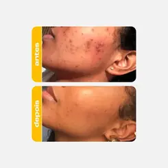 SERUM FACIAL ACIDO LATICO CREAMY - RENOVADOR SUAVE 30ML